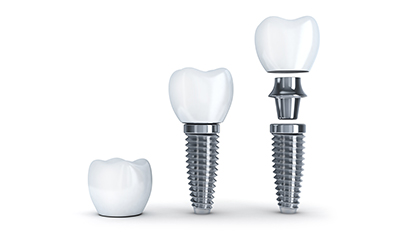 Implant dentaire Avignon